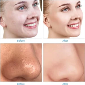 Peeling Diamante Dermoabrasão Sucção Remover Cravos Espinhas - Imagem 4