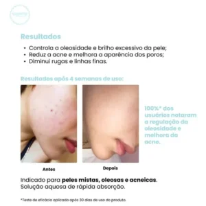 Creamy skincare ácido salicílico 90ml | tônico antioleosidade, rápida absorção, diminui o brilho excessivo, diminui os cravos | peles mistas, oleosas, noturno e diurno - Imagem 2