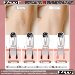 Depilador A Laser 990 Mil Pulsos 9 Marchas Três Modos Zcco - Imagem 10